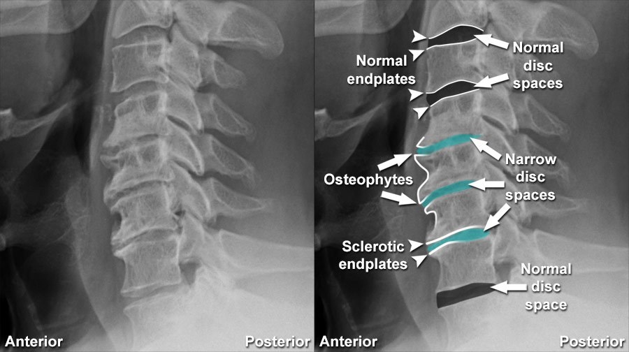 x-ray of spine with disc degeneration