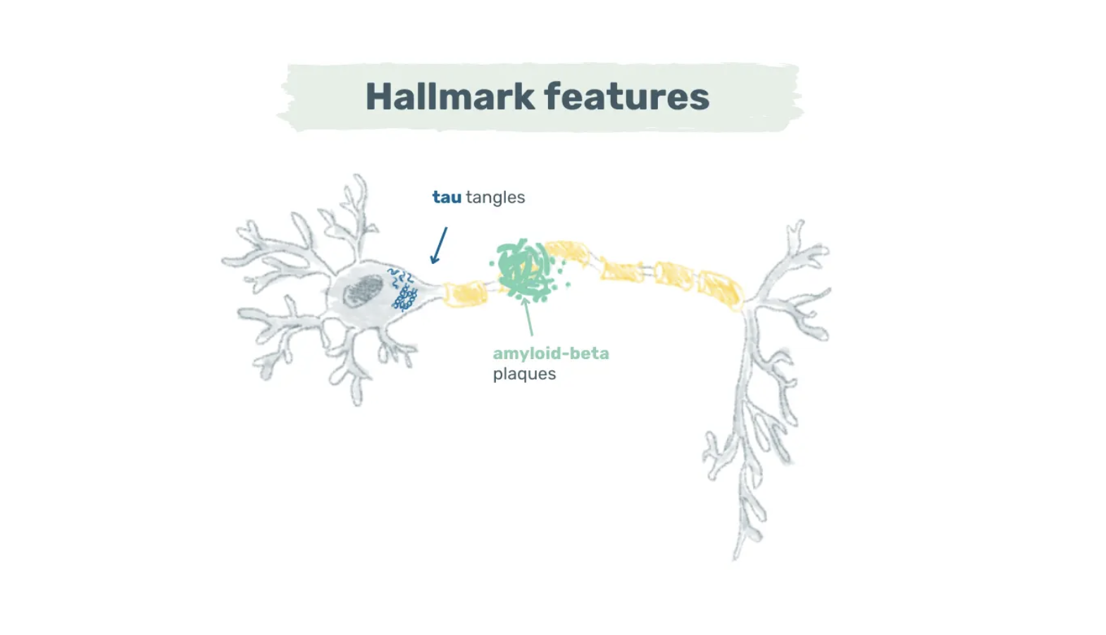 alzheimer's brain,plaques,amyloid,inflammation